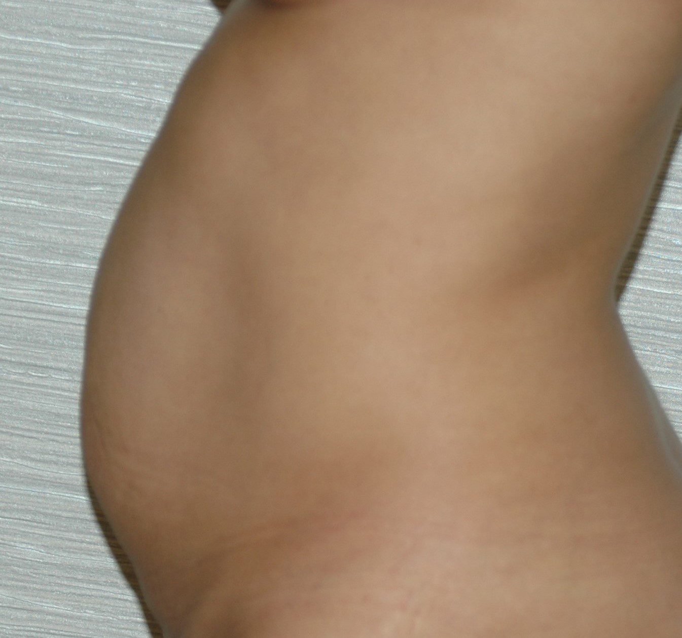 Tummy Tuck Surgery or Abdominoplasty in dubai