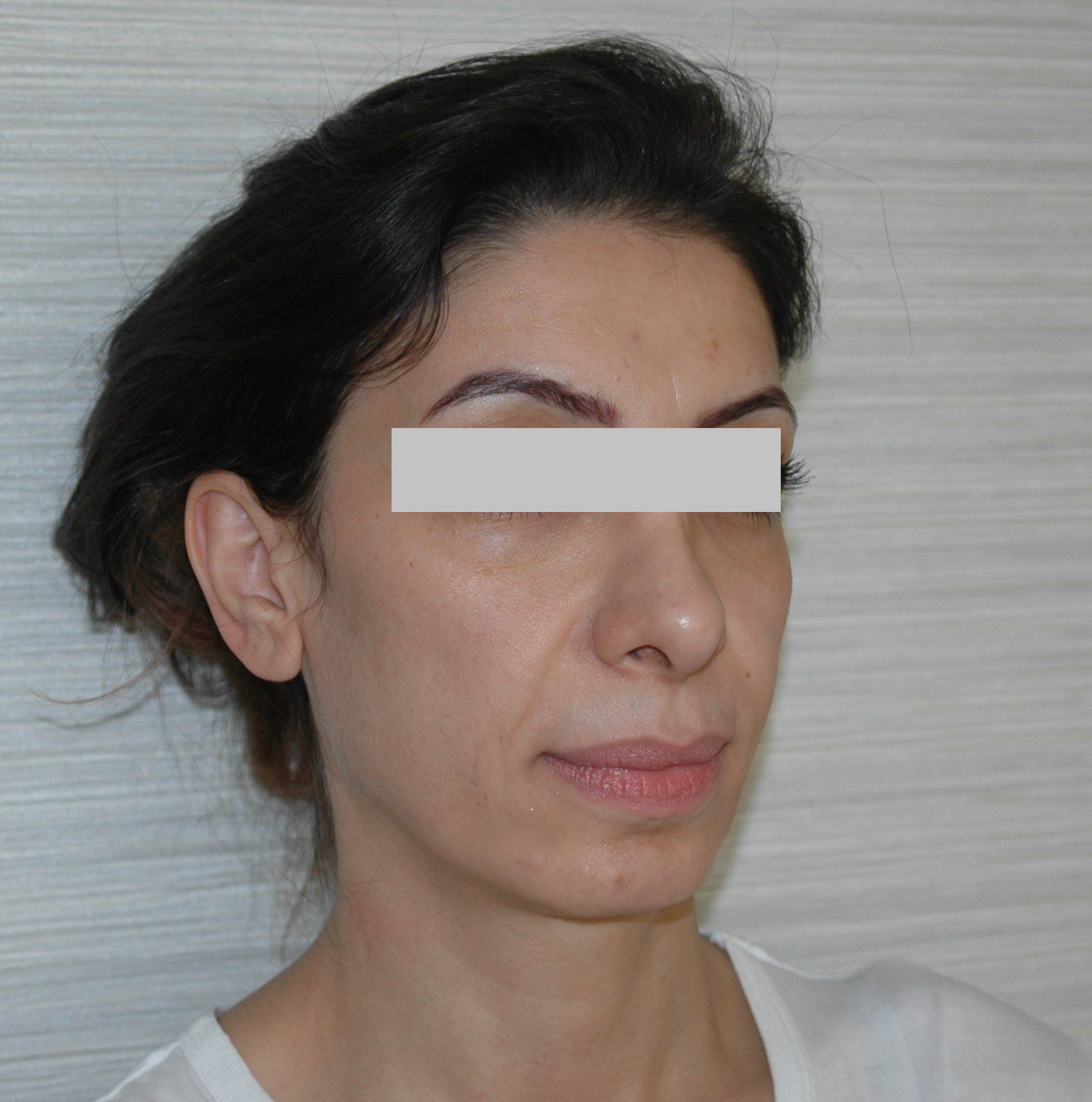 Fat Filler Treatment in dubai after image