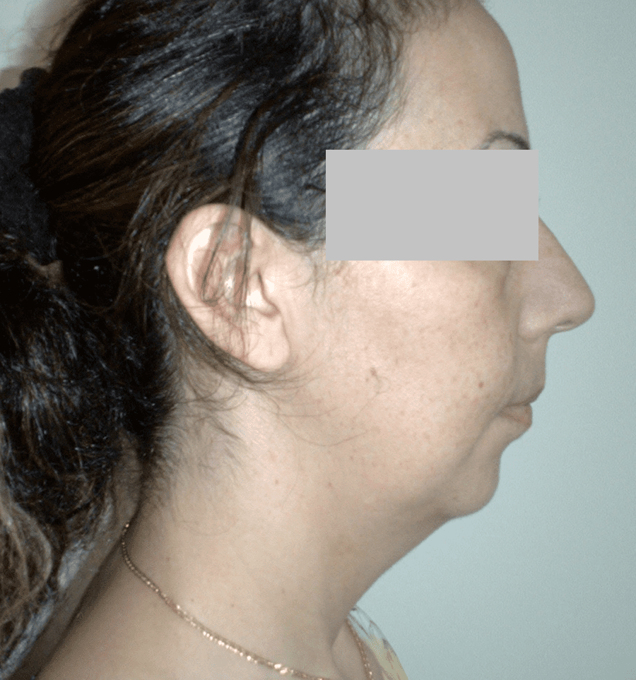 Liposuction treatment in dubai
