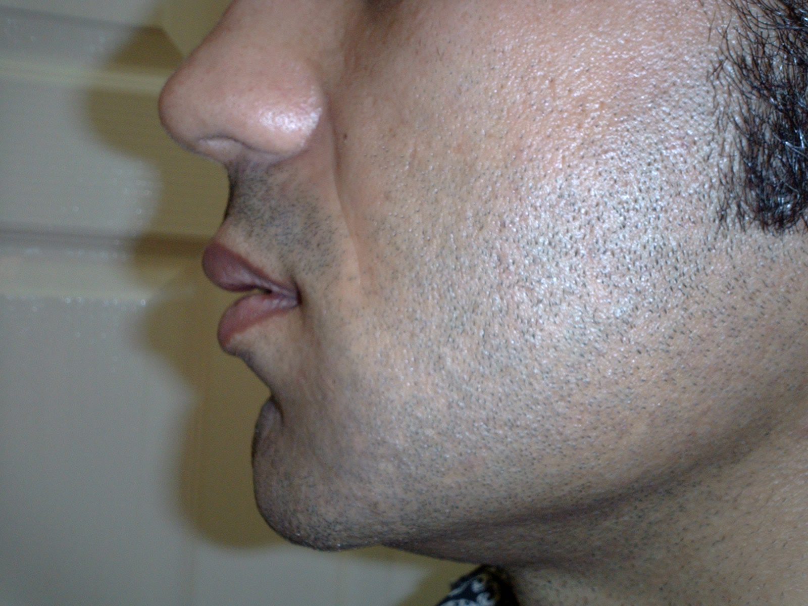 Surgical Lip Augmentation in dubai