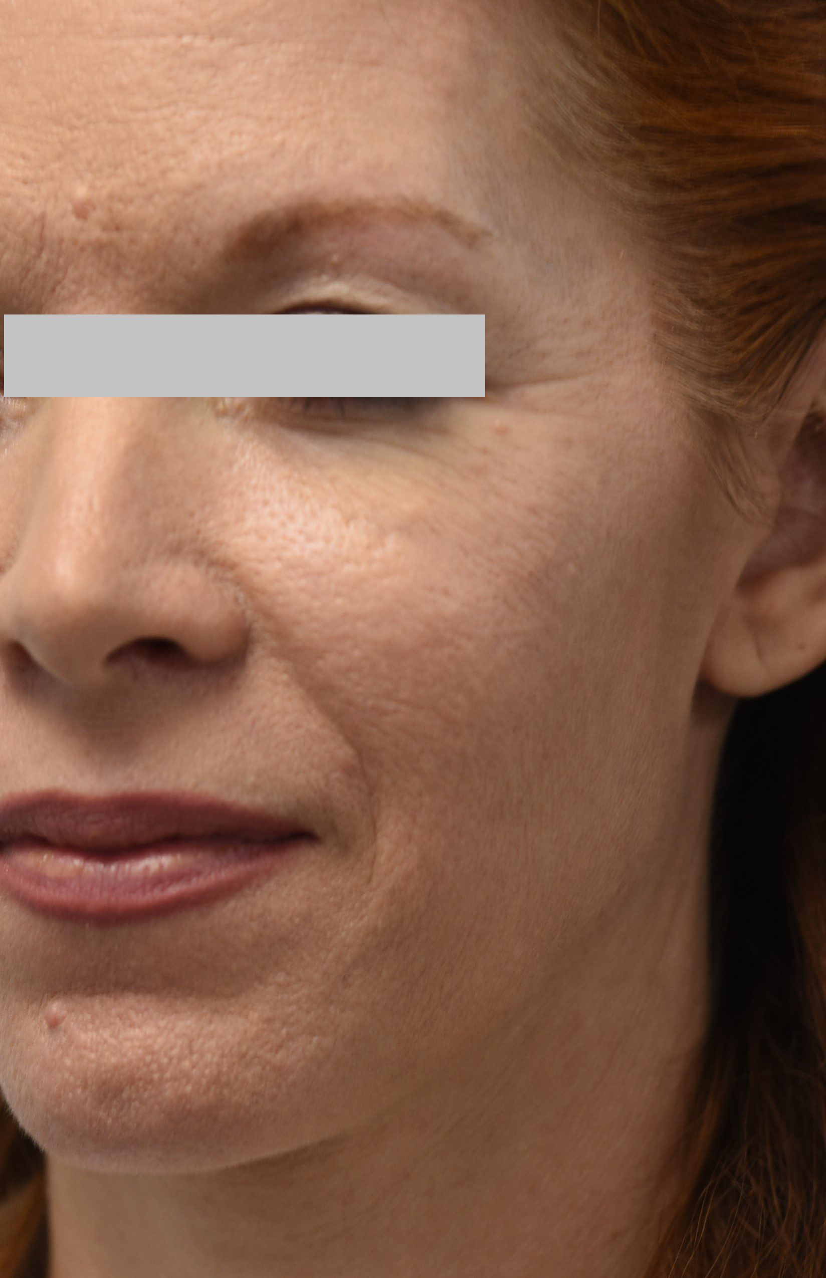 Hyaluronic Fillers after image