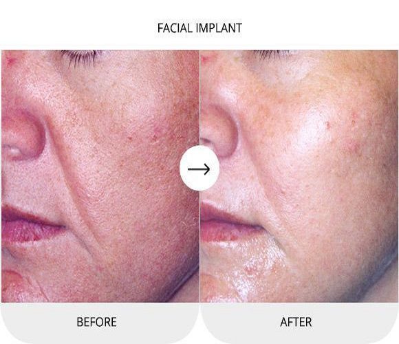 Facial Implants Dubai