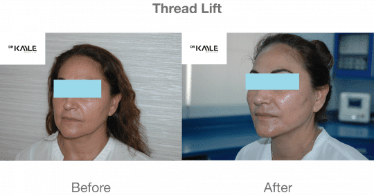 Non Surgical Face Rejuvenation||Non-Surgical Facial Rejuvenation