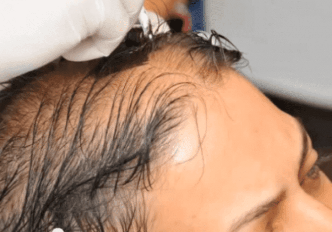 Hair Regrowth Treatment in Dubai