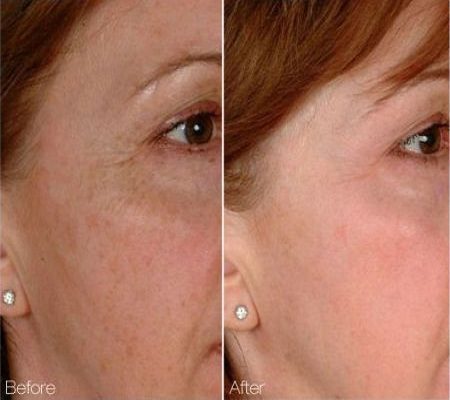 Laser Facial Rejuvenation in Dubai, before and after image