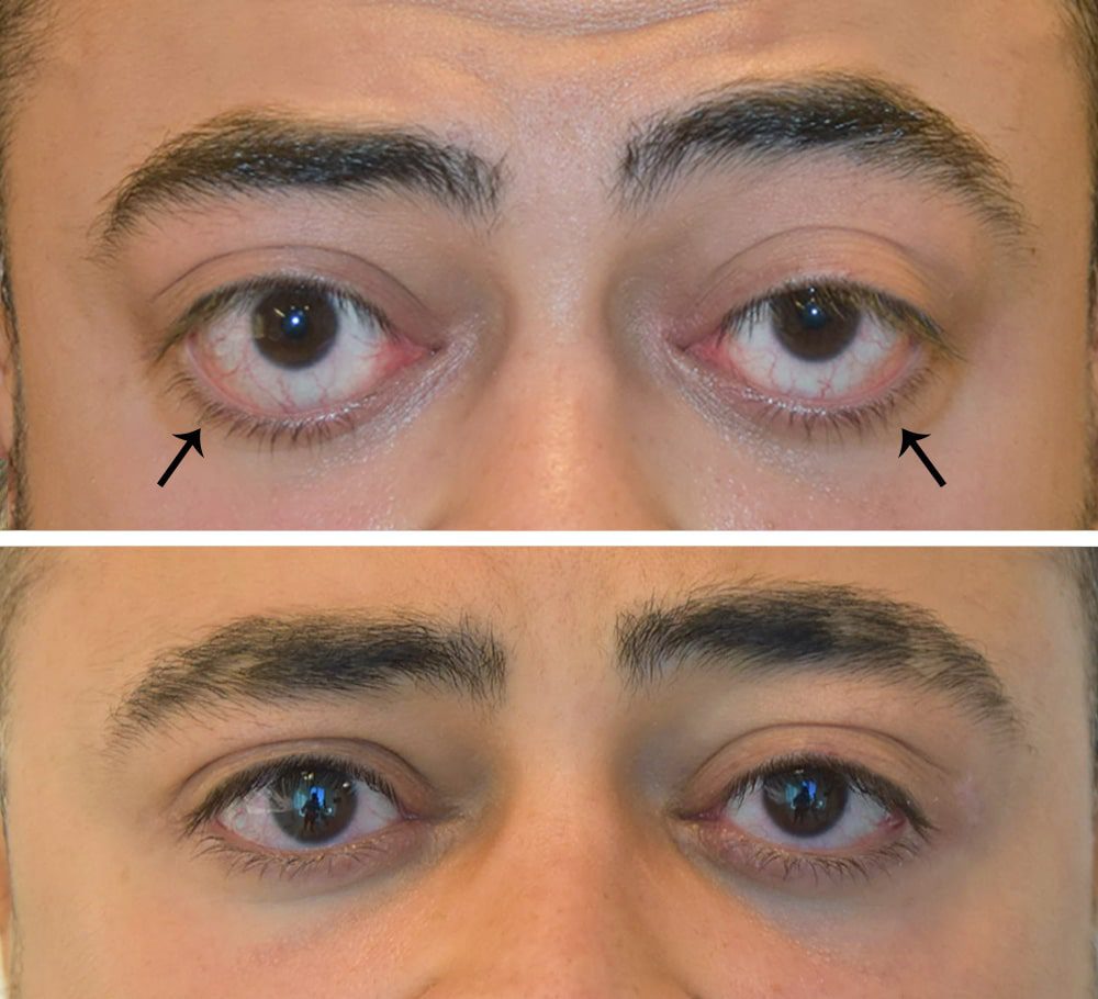 Oculoplastic treatment in dubai