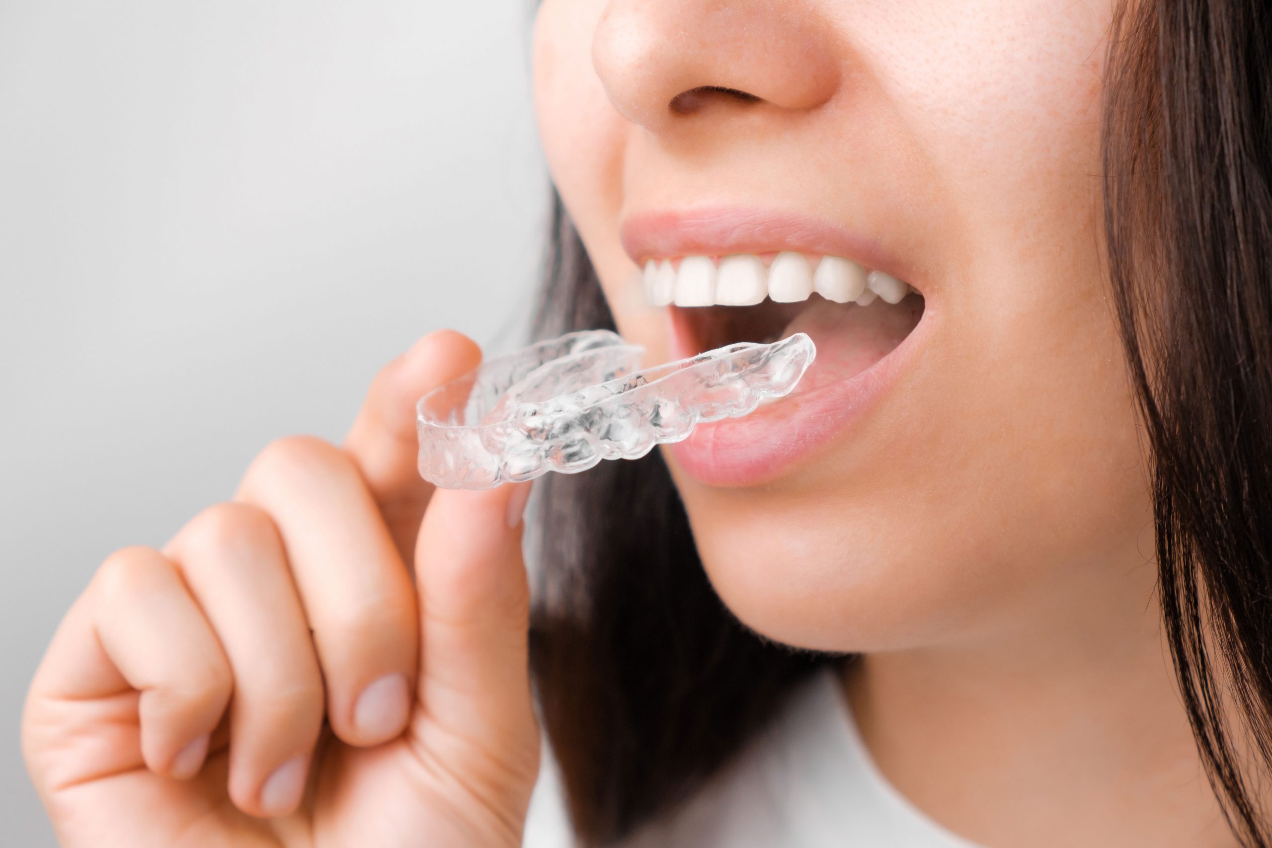 Advantages Of Invisalign Trays Over Other Conventional Orthodontic  treatments  Home - Dental Clinic In Dubai, Dentist In Dubai, Cosmetic  Dentistry, Dental Implants, Root Canal Treatment RCT, Teeth Whitening,  Dental Braces, Veneers