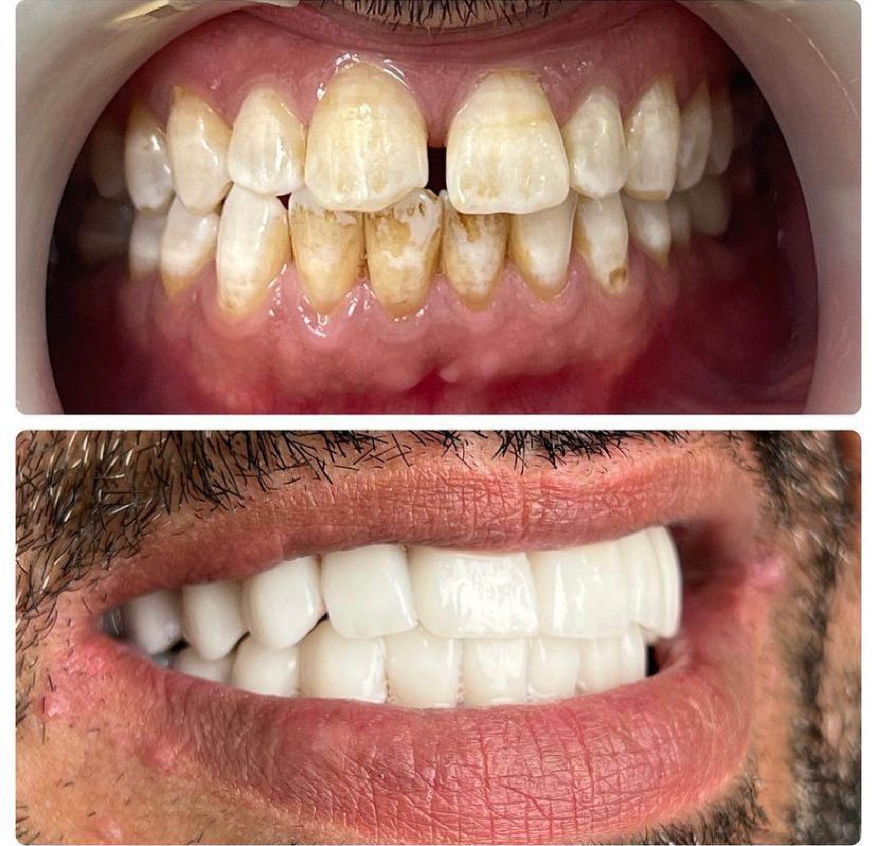 Cosmetic Dentistry - Before and After