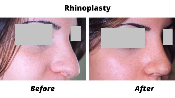 Nose Job Before and After