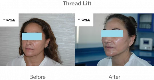 Thread Lift Dubai
